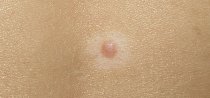 Halo nevus jeb gaiša āda ap veidojumu