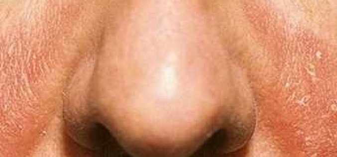 Seborejiskais dermatīts pieaugušajiem