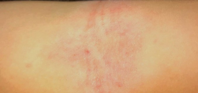 Atopiskais dermatīts