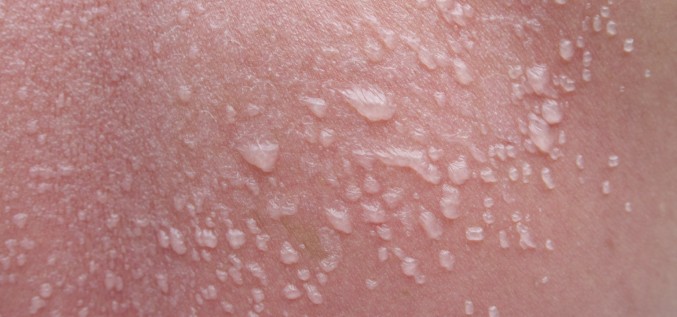 Ko darīt, ja pēc sauļošanās parādījušies nelieli ādas pūslīši?