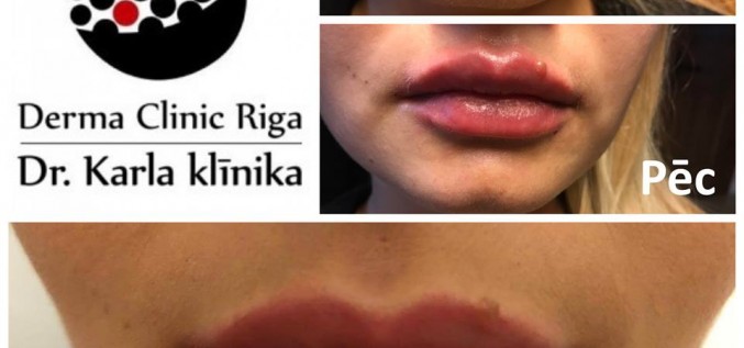 Lūpu apjoma palielināšana