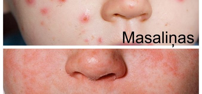 Masalas vai masaliņas?