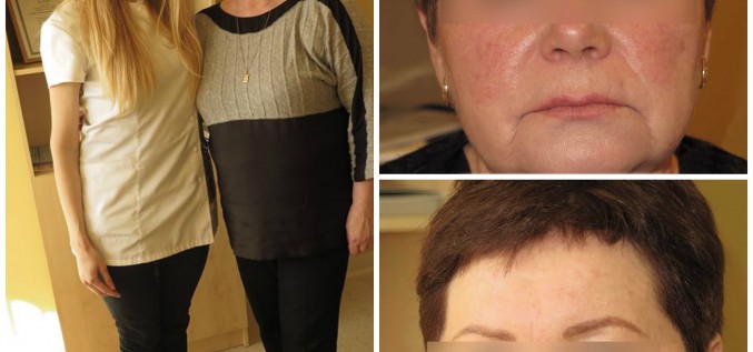 Projekts sadarbībā ar La Roche-Posay: rozācijas mazināšana