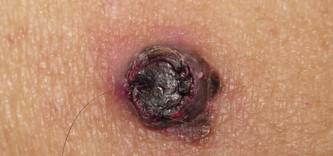 Ļaundabīgu ādas veidojumu likvidēšana, sekas