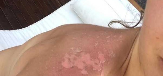 Apdedzinājies saulē? Ko darī tālāk?