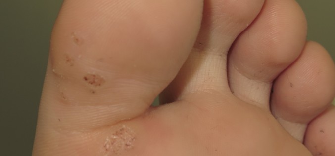 Что такое подошвенные вирусные бородавки (Verruca)?