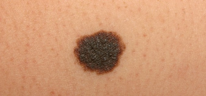 Traumēta dzimumzīme