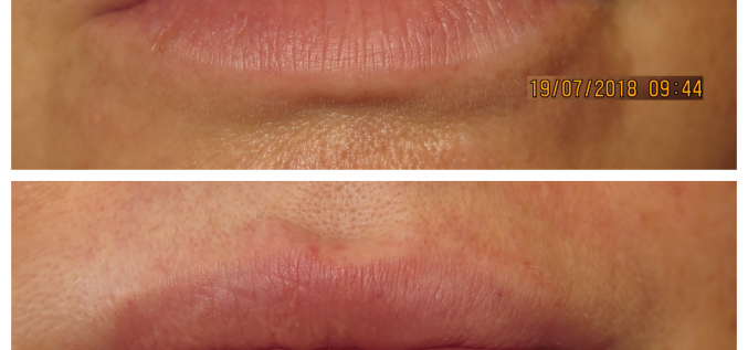 Pirms un pēc lūpu apjoma palielināšanas