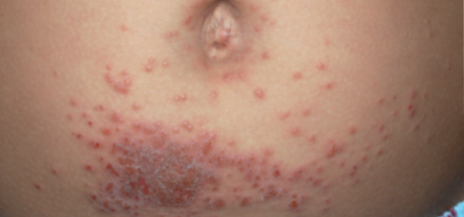 Alerģiskais kontaktdermatīts