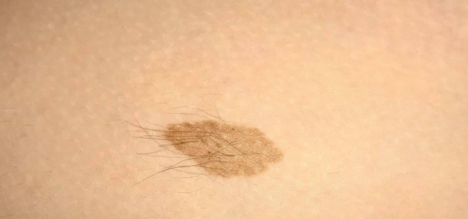 5 mīti par ādas veidojumiem