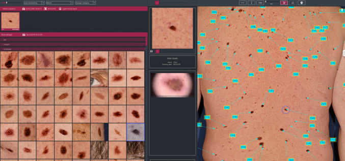 Картирование кожных образований с помощью FOTOFINDER