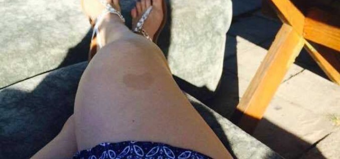 Kā rīkoties, ja pēc vasaras liekas, ka viena no dzimumzīmēm ir palielinājusies?