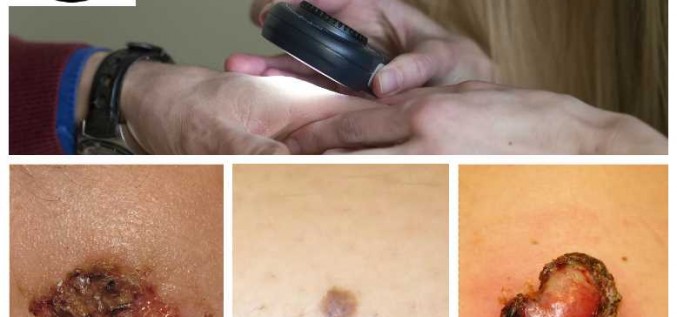 Neatliec vizīti pie dermatologa!