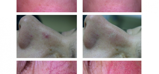 Labdabīgu veidojumu likvidēšana izmantojot Diodes lāzeru