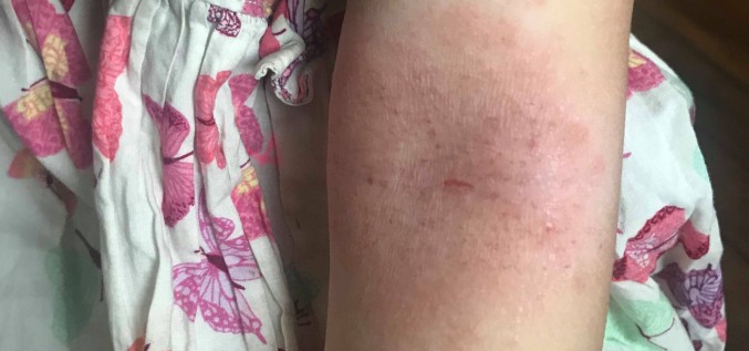 Atopiskais dermatīts - galvenie ieteikumi vecākiem
