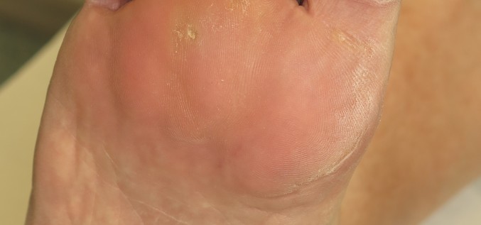 Кожная мозоль