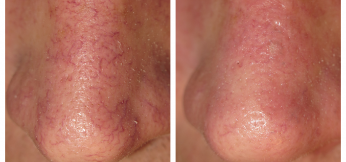 Asinsvadu likvidēšana izmantojot diodes lāzera procedūru