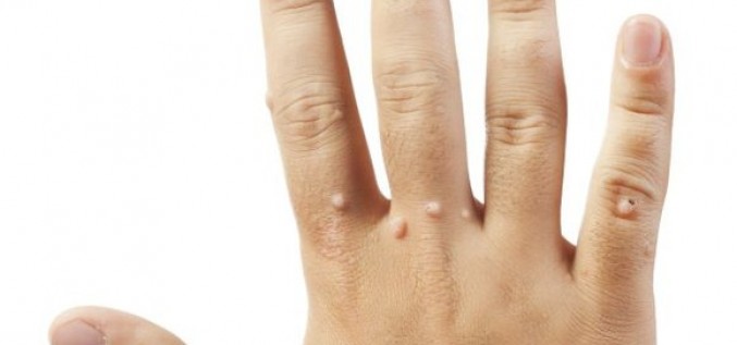 Nesāpīga kārpu ārstēšana