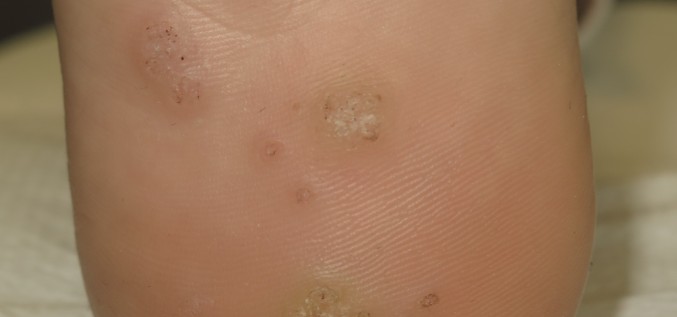 Можно ли удалить бородавки?