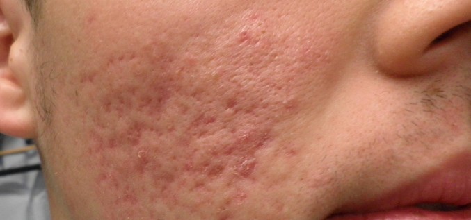 Kas man būtu jāzin par aknes ārstēšanu?