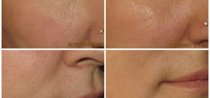 Eucerin projekta noslēgums